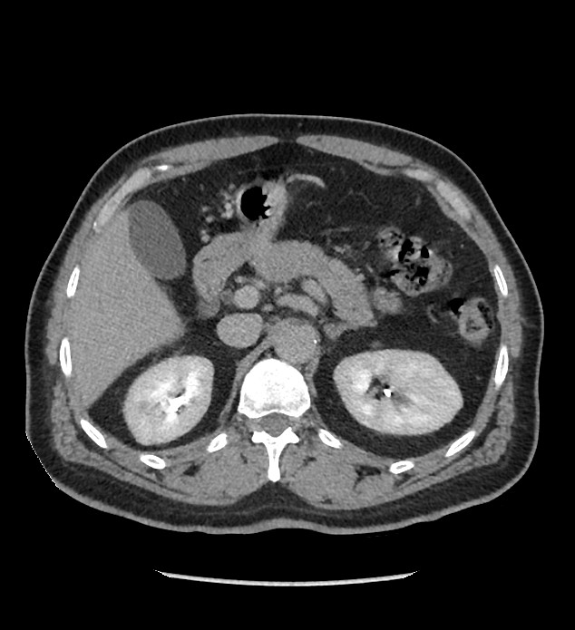 Chromophobe renal cell carcinoma (Radiopaedia 86879-103083 D 43).jpg