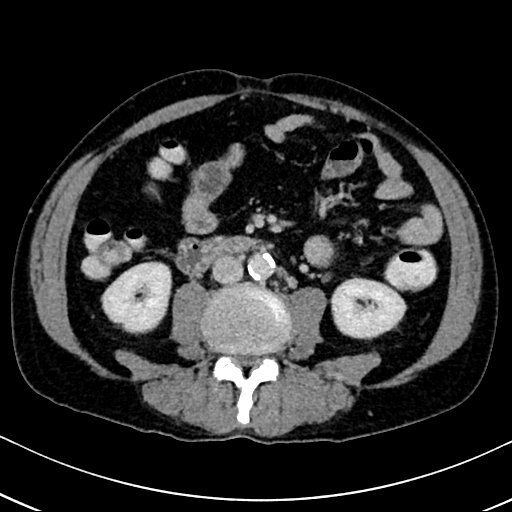 Chronic appendicitis complicated by appendicular abscess, pylephlebitis and liver abscess (Radiopaedia 54483-60700 B 82).jpg