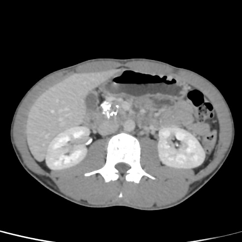 File:Chronic calcific pancreatitis (Radiopaedia 56280-62953 C 25).jpg