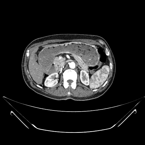 Chronic contained rupture of abdominal aortic aneurysm with extensive erosion of the vertebral bodies (Radiopaedia 55450-61901 A 14).jpg