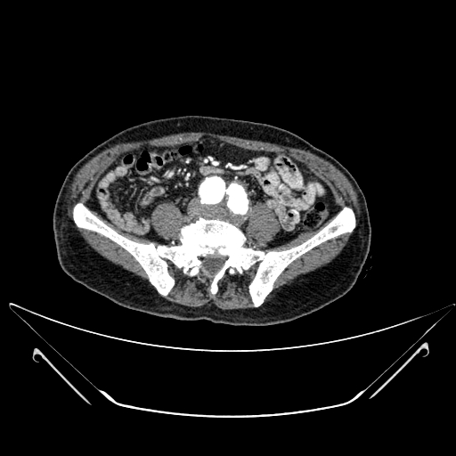 File:Chronic contained rupture of abdominal aortic aneurysm with extensive erosion of the vertebral bodies (Radiopaedia 55450-61901 A 48).jpg