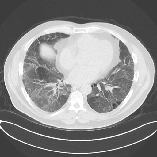 Chronic hypersensitivity pneumonitis (Radiopaedia 48107-52922 Axial lung window 38).png