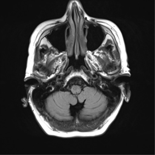 File:Chronic hypertensive encephalopathy (Radiopaedia 39993-42482 Axial FLAIR 3).png