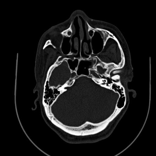 Chronic invasive fungal sinusitis (Radiopaedia 91563-109286 Axial sinus 46).jpg
