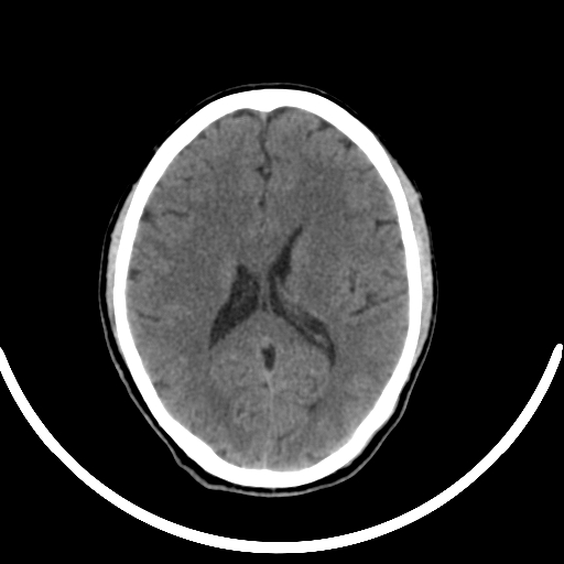 Chronic invasive fungal sinusitis with intraorbital and intracranial extension (Radiopaedia 56387-63046 Axial non-contrast 227).jpg