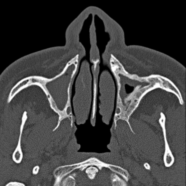 Chronic maxillary sinusitis (Radiopaedia 27879-28116 Axial bone window 11).jpg