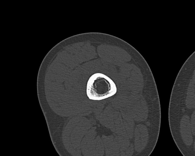 File:Chronic ostemyelitis of the femur with long sinus tract (Radiopaedia 74947-85982 Axial bone window 113).jpg