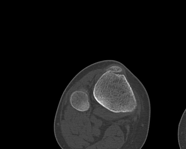 Chronic ostemyelitis of the femur with long sinus tract (Radiopaedia 74947-85982 Axial bone window 247).jpg