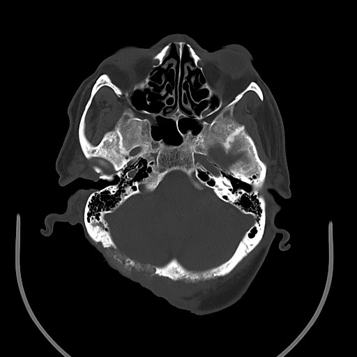 File:Chronic osteomyelitis - calvarial (severe) (Radiopaedia 69668-79616 Axial 9).jpg