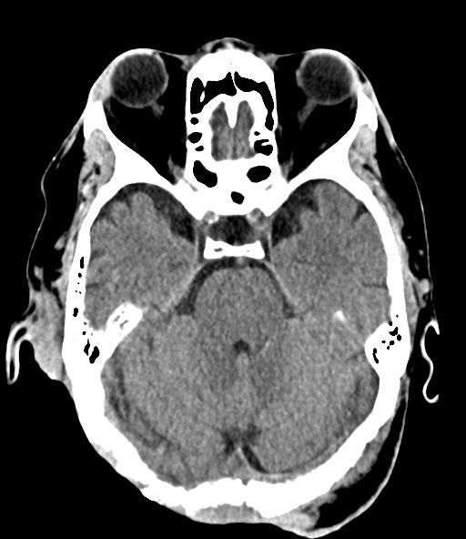 File:Chronic osteomyelitis - calvarial (severe) (Radiopaedia 69668-79616 Axial non-contrast 37).jpg