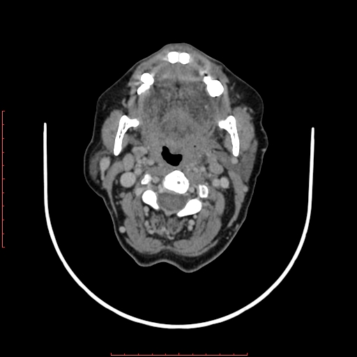 File:Chronic osteomyelitis - maxilla (Radiopaedia 23783-23927 B 35).jpg