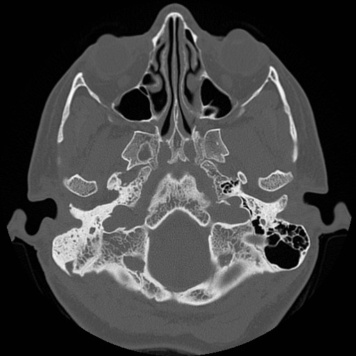 File:Chronic otomastoiditis (Radiopaedia 27138-27309 Axial bone window 11).jpg