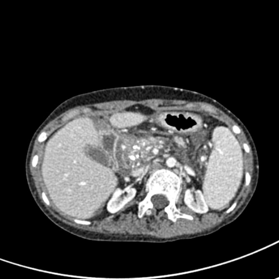 Chronic pancreatitis (Radiopaedia 55405-61846 A 36).jpg