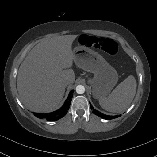 File:Chronic pulmonary embolus (Radiopaedia 39129-41341 Axial C+ CTPA 95).png