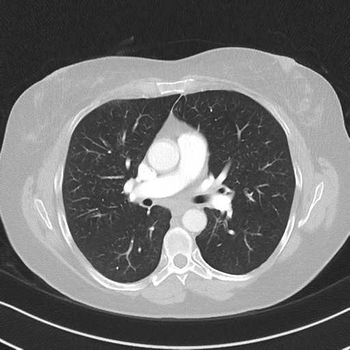 Chronic pulmonary embolus (Radiopaedia 39129-41341 Axial lung window 30).png