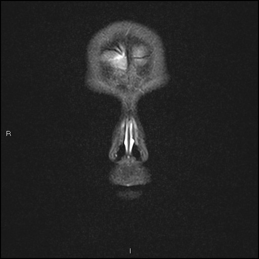 File:Chronic reactive multifocal osteomyelitis (CRMO) - mandible (Radiopaedia 56405-63069 Coronal STIR 3).jpg