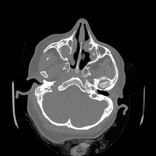 File:Chronic sinusitis with intra-sinus calcification (Radiopaedia 63919-72668 Axial bone window 48).jpg