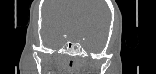 Chronic sphenoidal sinusitis (Radiopaedia 62030-70122 Coronal bone window 134).jpg