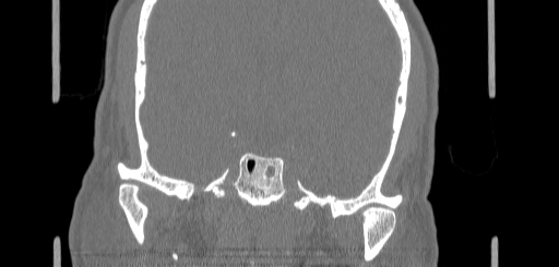 Chronic sphenoidal sinusitis (Radiopaedia 62030-70122 Coronal bone window 139).jpg