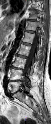 File:Chronic spinal hematoma with cauda equina syndrome (Radiopaedia 75745-87090 Sagittal T1 6).png