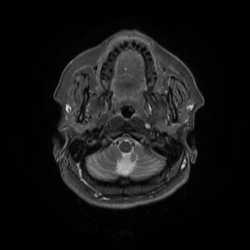 File:Chronic submandibular sialadenitis (Radiopaedia 61852-69885 Axial STIR 7).jpg