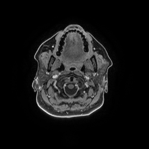 Chronic submandibular sialadenitis (Radiopaedia 61852-69885 Axial T1 C+ fat sat 89).jpg
