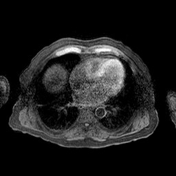 Cirrhosis and hepatocellular carcinoma in the setting of hemochromatosis (Radiopaedia 75394-86594 Axial T1 C+ fat sat 83).jpg