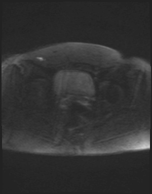 Class II Mullerian duct anomaly- unicornuate uterus with rudimentary horn and non-communicating cavity (Radiopaedia 39441-41755 Axial DWI 84).jpg