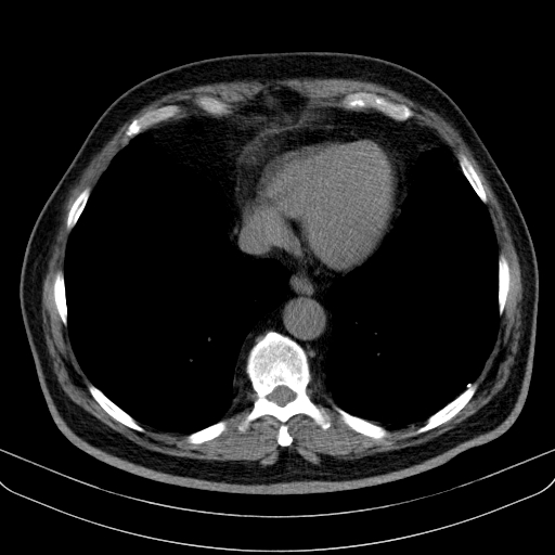 File:Classic complicated silicosis (Radiopaedia 49720-54961 Axial liver window 42).jpg