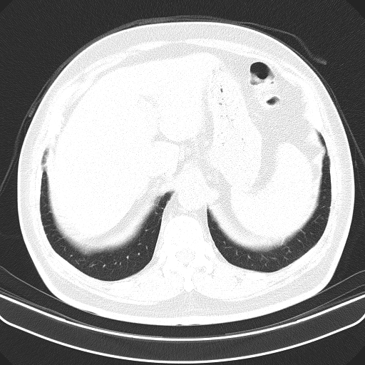 Classic complicated silicosis (Radiopaedia 49720-54961 Axial lung window 54).jpg