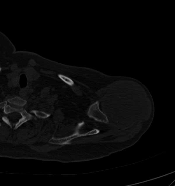 Clear cell chondrosarcoma - humerus (Radiopaedia 63104-71612 Axial bone window 23).jpg