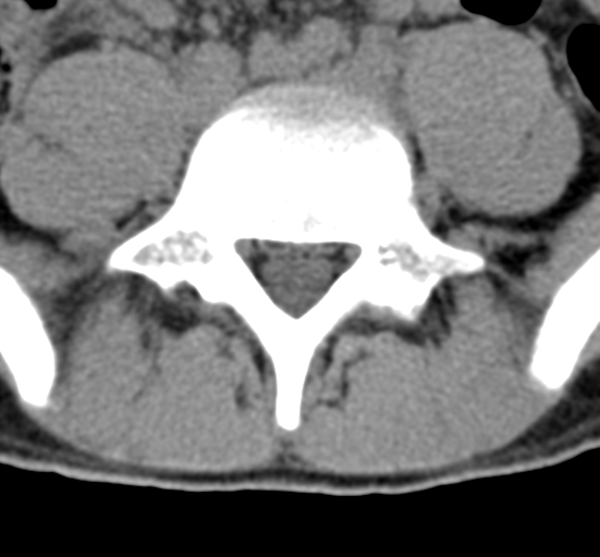 File:Clear cell meningoma - lumbar spine (Radiopaedia 60116-67691 Axial non-contrast 59).png