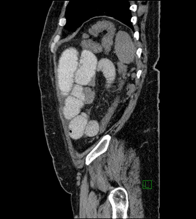 Closed-loop small bowel obstruction-internal hernia (Radiopaedia 78439-91096 C 33).jpg