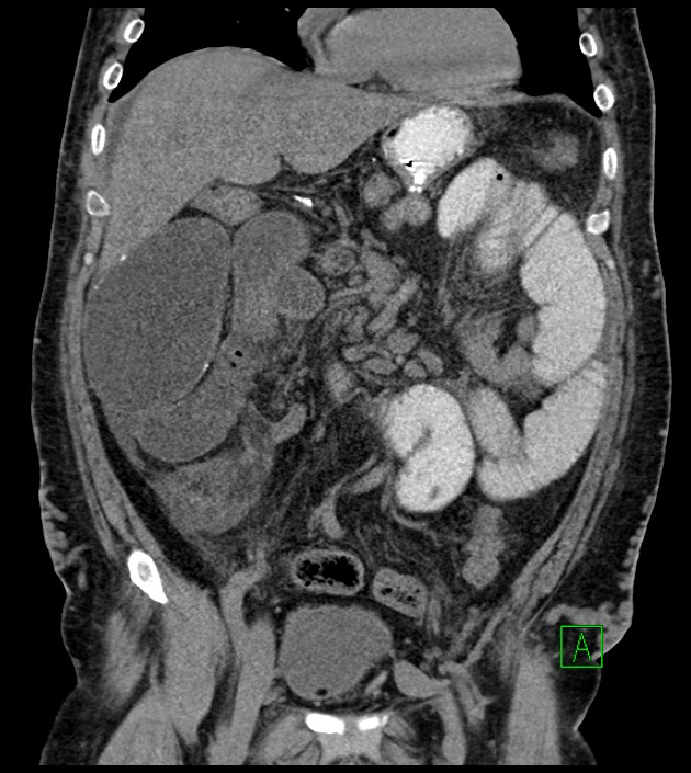 Closed-loop small bowel obstruction-internal hernia (Radiopaedia 78439-91096 Coronal non-contrast 43).jpg
