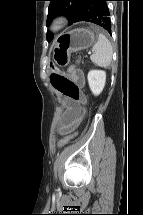 Closed loop bowel obstruction and ischemia (Radiopaedia 86959-103180 C 9).jpg