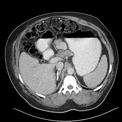 File:Closed loop obstruction - internal hernia into nephrectomy bed (Radiopaedia 59867-67320 A 39).jpg