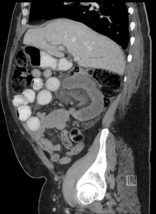 Closed loop obstruction - internal hernia into nephrectomy bed (Radiopaedia 59867-67320 C 71).jpg