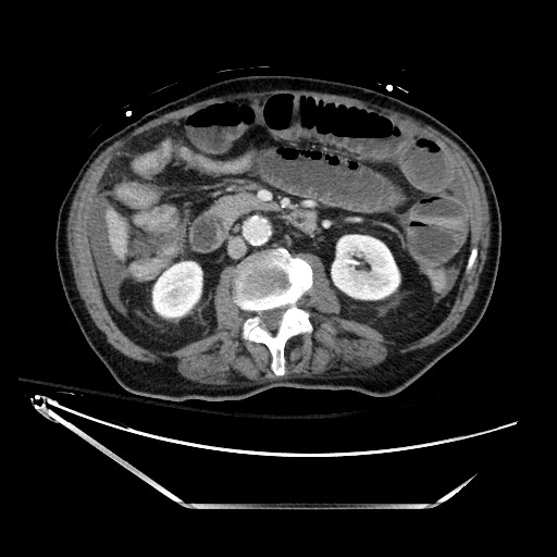 Closed loop obstruction due to adhesive band, resulting in small bowel ischemia and resection (Radiopaedia 83835-99023 D 71).jpg