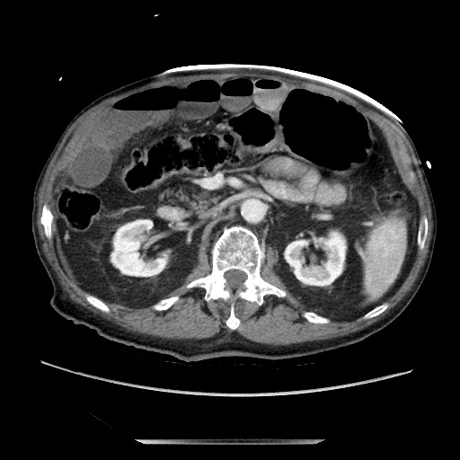 Closed loop small bowel obstruction - adhesive disease and hemorrhagic ischemia (Radiopaedia 86831-102990 A 79).jpg