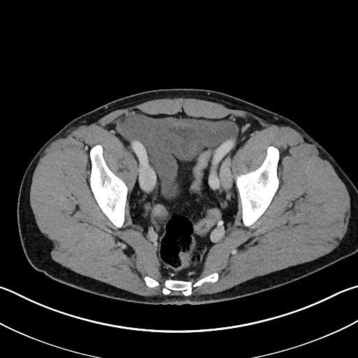 Closed loop small bowel obstruction - internal hernia (Radiopaedia 57806-64778 B 109).jpg