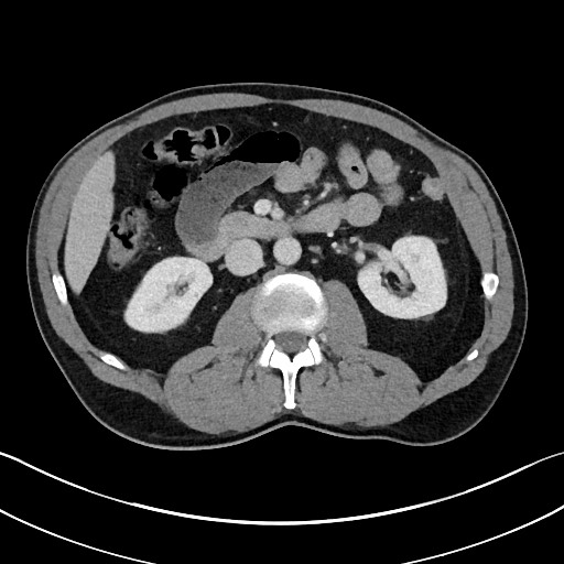 Closed loop small bowel obstruction - internal hernia (Radiopaedia 57806-64778 B 52).jpg