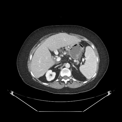 Closed loop small bowel obstruction - internal hernia (Radiopaedia 65402-74450 A 34).jpg