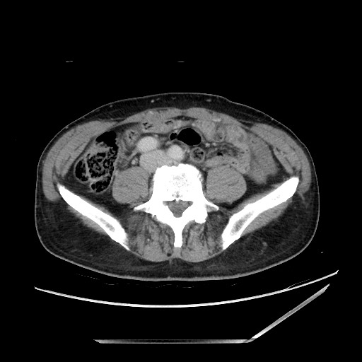 Closed loop small bowel obstruction - omental adhesion causing "internal hernia" (Radiopaedia 85129-100682 A 107).jpg