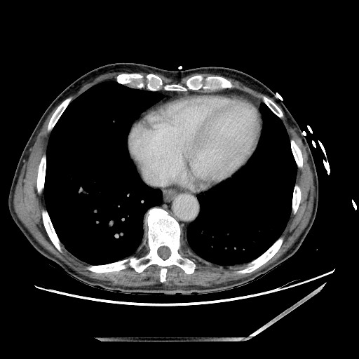 Closed loop small bowel obstruction - omental adhesion causing "internal hernia" (Radiopaedia 85129-100682 A 4).jpg