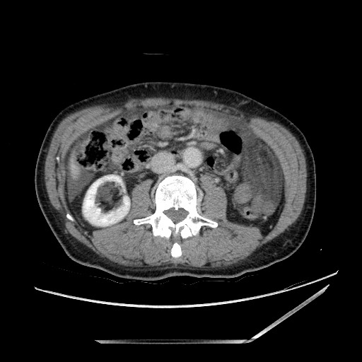 Closed loop small bowel obstruction - omental adhesion causing "internal hernia" (Radiopaedia 85129-100682 A 80).jpg