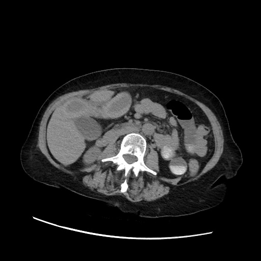Closed loop small bowel obstruction due to adhesive band, with intramural hemorrhage and ischemia (Radiopaedia 83831-99017 Axial non-contrast 78).jpg