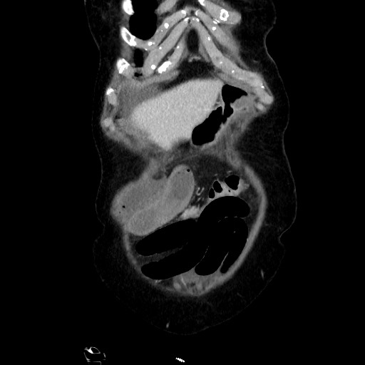 Closed loop small bowel obstruction due to adhesive band, with intramural hemorrhage and ischemia (Radiopaedia 83831-99017 C 23).jpg