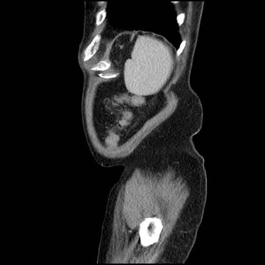 Closed loop small bowel obstruction due to adhesive band - U-shaped loop (Radiopaedia 83829-99012 C 10).jpg