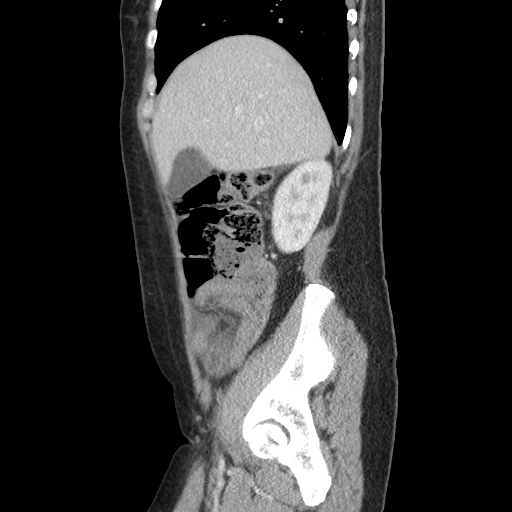 Closed loop small bowel obstruction due to trans-omental herniation (Radiopaedia 35593-37109 C 18).jpg