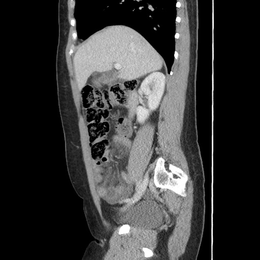 File:Closed loop small bowel obstruction due to trans-omental herniation (Radiopaedia 35593-37109 C 24).jpg